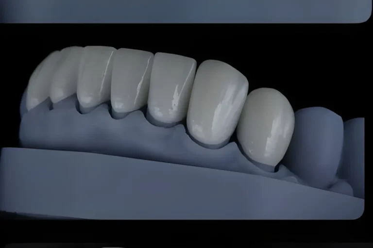 Veneers